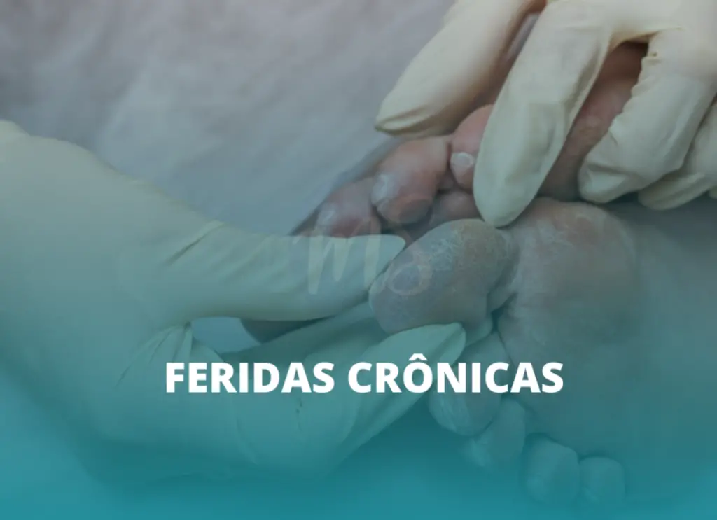 Estomaterapeuta trata ferida crônica e promove autocuidado eficaz