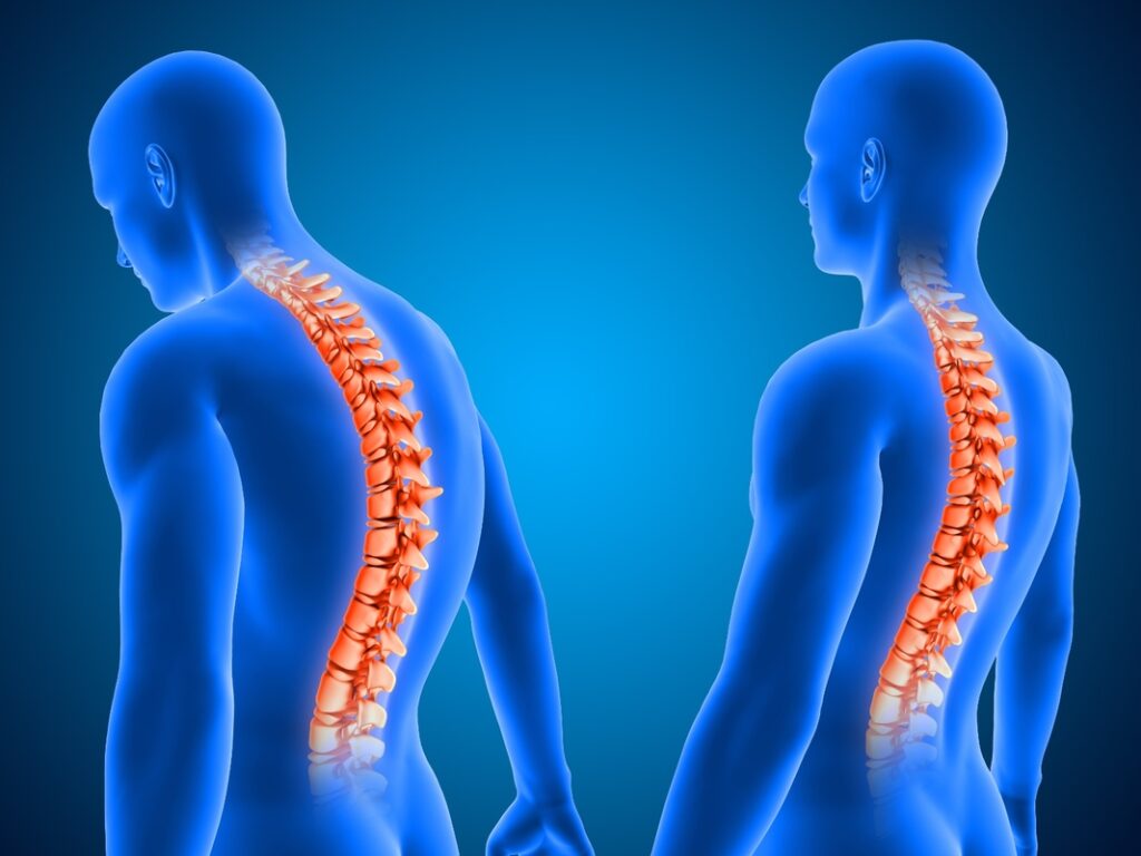 Cirurgia de escoliose é a 1ª com neuronavegação em Uberlândia