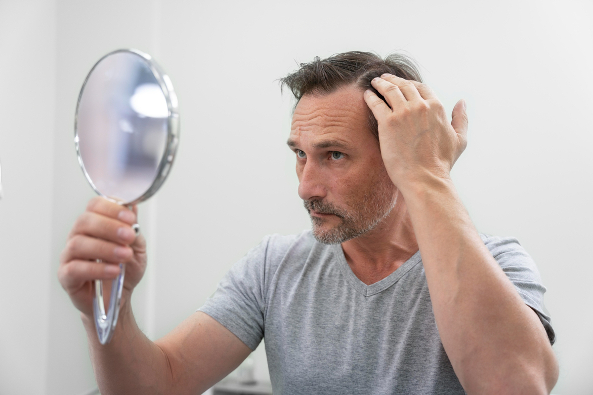 Tratamentos ampliam alternativas para calvície masculina